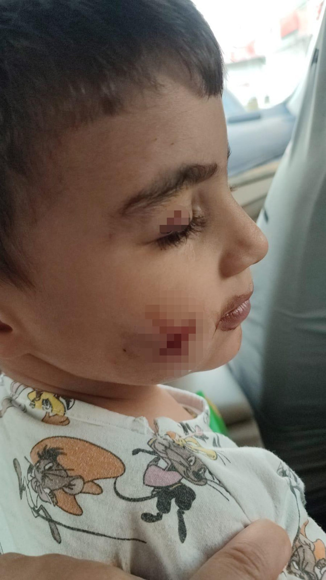 Küçük çocuk uyurken korku dolu anlar yaşadı! Yüzünü lağım faresi ısırdı