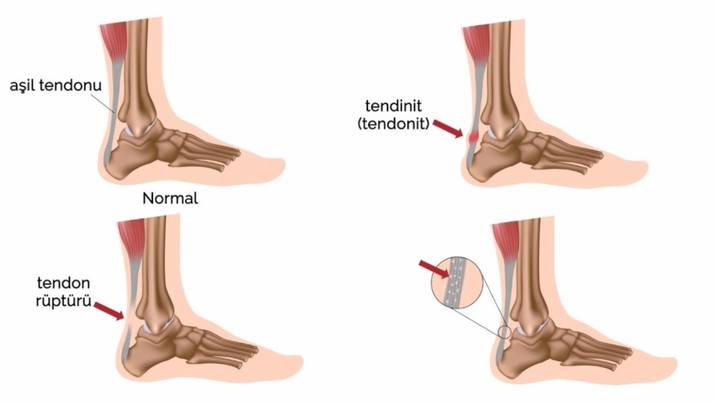 Aşil tendonu kopması nedir? Aşil tendonu nerede, nasıl tedavi edilir? İşte tüm detaylar… - Resim : 2