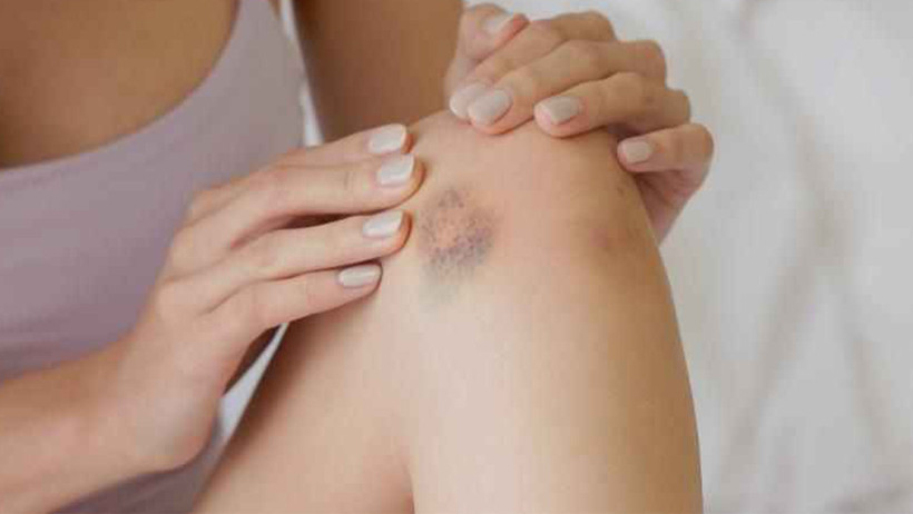 Kendiliğinden beliren morluklara dikkat: Yatağa bağımlı hale getirebiliyor