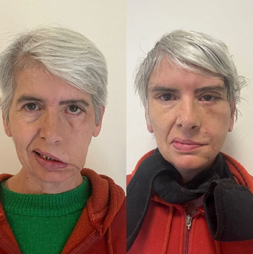 Gözüne takılan altın implantla hayatı kurtuldu! 41 yıl sonra rüya görmeye başladım